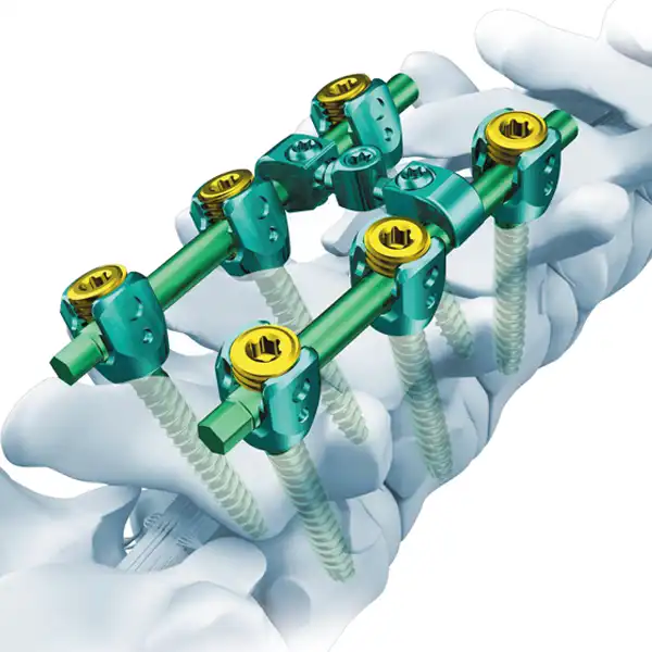 Spinal internal fixation system